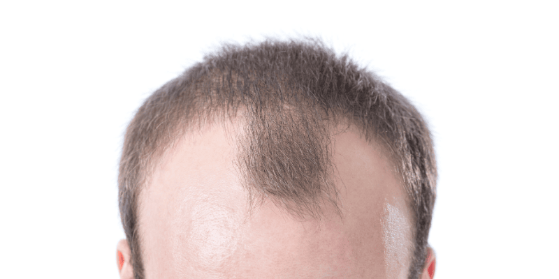 What Causes a Receding Hairline?