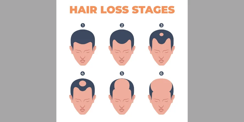 Hair Loss Norwood Scale 