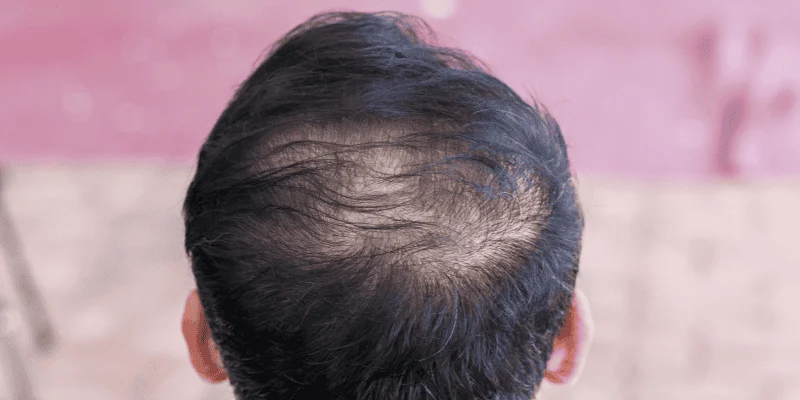 Hair Loss Facts