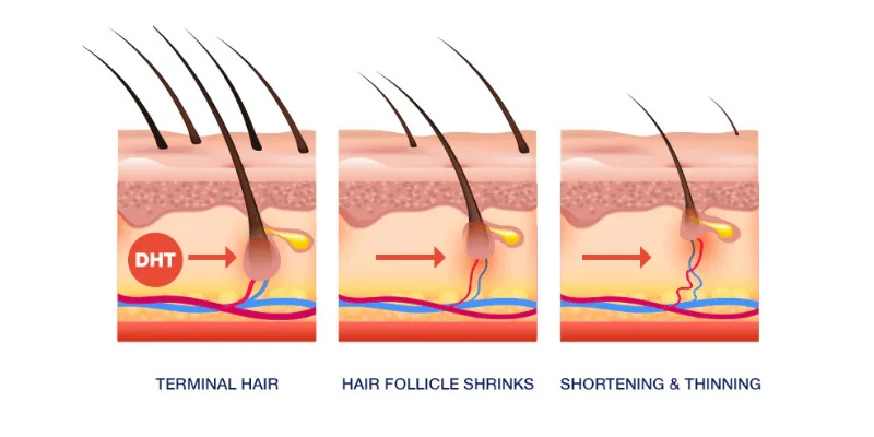 Hair Fall Causes in Men: What’s Really Behind It?