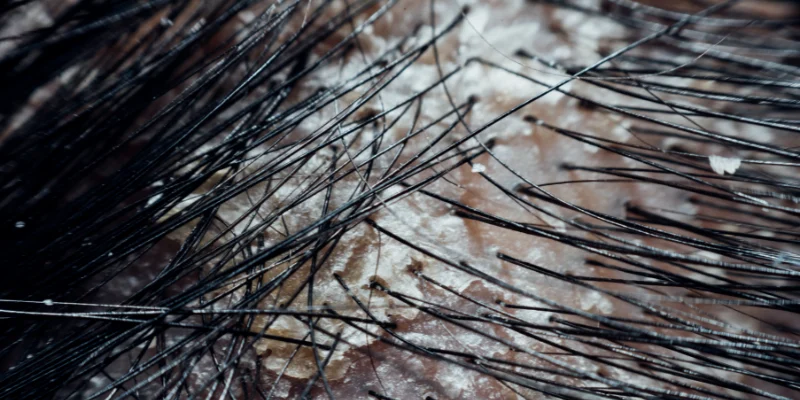 Microbiome-Centered Scalp Care