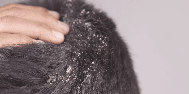 Why Do We Get Dandruff