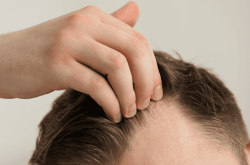 How to Treat a Receding Hairline Best Solutions That Work