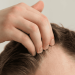 How to Treat a Receding Hairline Best Solutions That Work