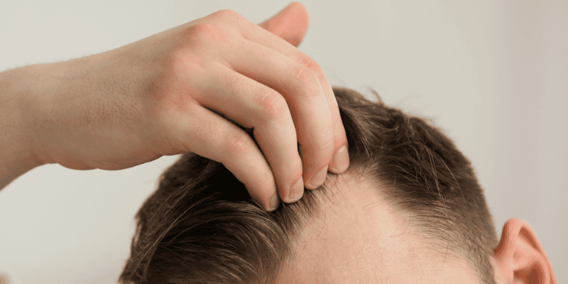 How to Treat a Receding Hairline Best Solutions That Work