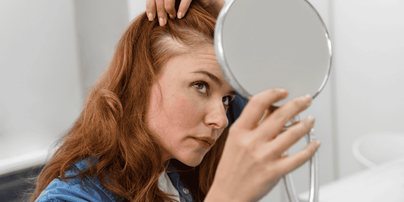 Signs of Hormonal Hair Loss